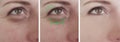 Woman wrinkles face swollen removal lifting blepharoplasty therapy contrast before treatment difference sagging correction