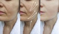 Woman wrinkles face before after rejuvenation  effect plastic therapy procedure treatment arrow thread lifting, Royalty Free Stock Photo