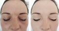 Woman wrinkles face before and after treatment cosmetology treatments