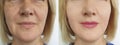 Woman wrinkles face before correction collage problem result tightening removal after treatment, double chin Royalty Free Stock Photo