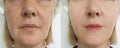 Woman wrinkles face before correction collage result tightening removal after treatment, double chin Royalty Free Stock Photo