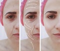 Woman wrinkles on face, treatment effect correction contrast before and after procedures, arrow Royalty Free Stock Photo