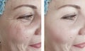 Woman wrinkles face before and after difference patient treatment Royalty Free Stock Photo