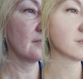 Woman wrinkles face before result correction mature plastic facelift collage after treatments procedure problem