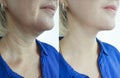 Woman wrinkles face before facelift collage after treatments procedure problem