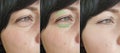 Woman wrinkles face swollen removal blepharoplasty therapy contrast before treatment difference sagging correction