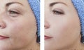 Woman wrinkles face beautician difference before and after treatments