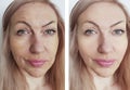 Woman wrinkles face before and after removal injection lifting therapy treatments Royalty Free Stock Photo