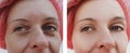 Woman wrinkles face removal patient before and after treatments cosmetology Royalty Free Stock Photo