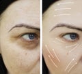 Woman wrinkles pigmentation difference photo-aging mature before and after rejuvenation procedures , Royalty Free Stock Photo