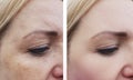 Woman wrinkles pigmentation dermatology face health before and after procedures Royalty Free Stock Photo