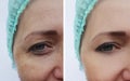 Woman wrinkles pigmentation face health before and after procedures
