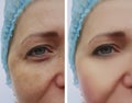Woman wrinkles pigmentation face before and after procedures