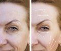 woman wrinkles before and after plastic collagen filler hydrating the procedure effect