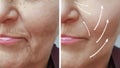 Woman wrinkles before and after collagen correction tension hydrating the procedure effect regeneration