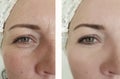 Woman wrinkles before after oval effect mature  cosmetology difference lift antiaging procedures Royalty Free Stock Photo