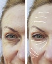 Woman wrinkles before and after procedures lifting, therapy Royalty Free Stock Photo