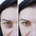 Woman wrinkles effect before and after rejuvenation procedures lifting, therapy Royalty Free Stock Photo