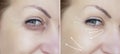 Woman wrinkles regeneration effect before and after procedures lifting, therapy Royalty Free Stock Photo