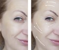 Woman wrinkles regeneration before and after procedures lifting, therapy Royalty Free Stock Photo