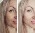 Woman wrinkles removal face biorevitalization before and after treatments