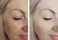 Woman wrinkles removal face lifting biorevitalization before and after treatments Royalty Free Stock Photo