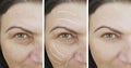 Woman wrinkles skin face lift results collagen removal rejuvenation therapy difference cosmetology before and after treatments Royalty Free Stock Photo