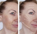 Woman wrinkles skin difference antiaging contours before and after regeneration Royalty Free Stock Photo