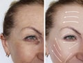 Woman wrinkles skin antiaging collagen before and after regeneration