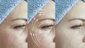 Woman wrinkles skin  after plastic  facial  collagen effect lifting procedure treatment, thread lifting Royalty Free Stock Photo