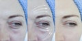 Woman wrinkles skin  after plastic  collagen effect lifting procedure treatment, thread lifting Royalty Free Stock Photo