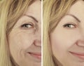 Woman wrinkles before and after therapy, ageing procedure biorevitalization treatments