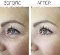 Woman wrinkles before and after treatment treatment anti, aging procedures