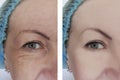 Woman wrinkles before and after removal correction cosmetology therapy, ageing procedure biorevitalization treatments Royalty Free Stock Photo