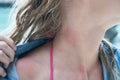 Woman's neck with jelly fish bite