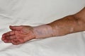 Woman& x27;s right hand damaged by vitiligo disease, palm up. Royalty Free Stock Photo