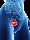 A womans bladder cancer Royalty Free Stock Photo