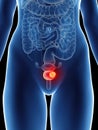 A womans bladder cancer Royalty Free Stock Photo