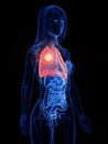 A womans lung tumor Royalty Free Stock Photo