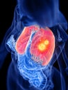 A womans lung tumor Royalty Free Stock Photo