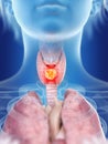 a womans thyroid gland cancer