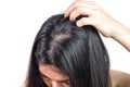 Women head with dandruff Caused by the problem of dirty. Or caused by skin disease or Seborrheic Dermatitis. It has white scaly