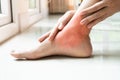 Women leg ankle injury/painful, women touch the pain ankle leg Royalty Free Stock Photo