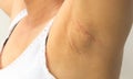 Women problem black armpit on white background for skin care and