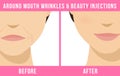 Cosmetic procedures botox