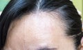 Women`s hair loss problem.It`s serious problem of women