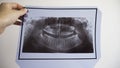 Women`s hand hold x-ray teeth scan Royalty Free Stock Photo