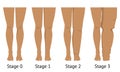 Women`s legs in different stages of Lymphedema