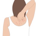 Women scratch the rash back itch because of allergies symptoms or nettle or eczema, illustration cartoon on white background