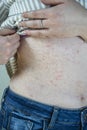 Women with symptoms of itchy urticaria or allergic reaction on the skin. Red rash on the females body Royalty Free Stock Photo